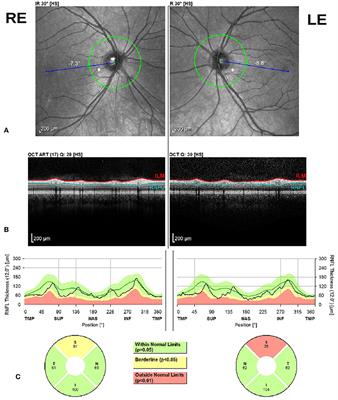 Optical Coherence Tomography in a Cohort of Genetically Defined Hereditary Spastic Paraplegia: A Brief Research Report